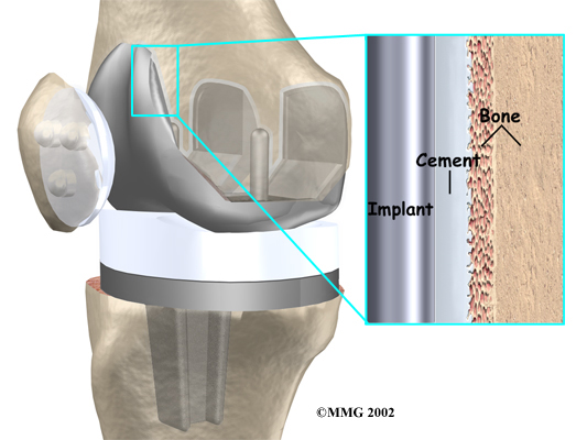 Minimally Invasive Knee Replacement Surgery Engineering Replacement
